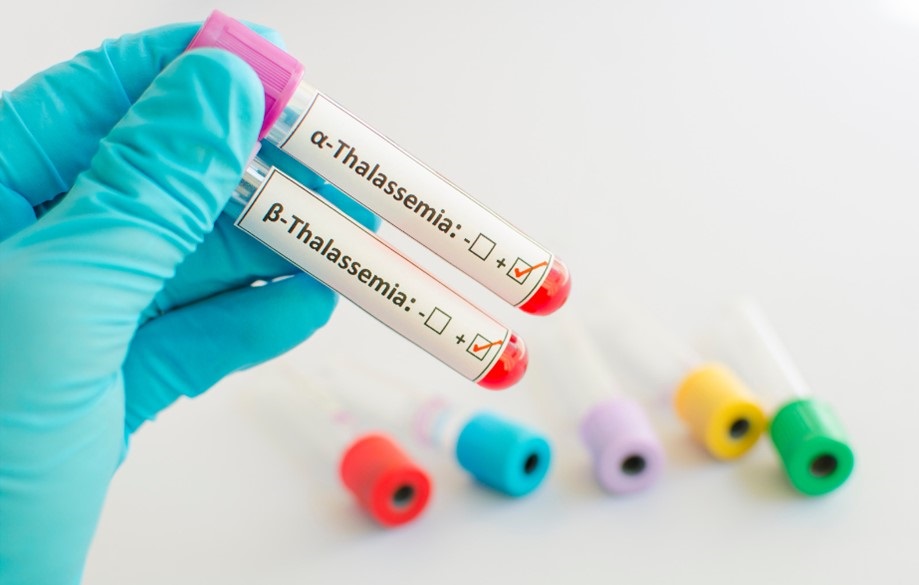 image of thalassemia testing in a vial