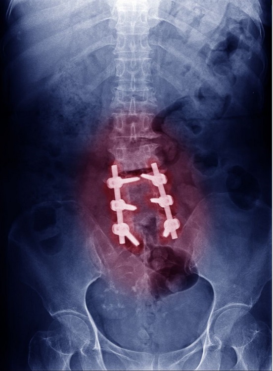 spinal stenosis x-ray