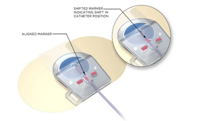 Illustration of a medical Catheter designed in the Medical Innovation Lab