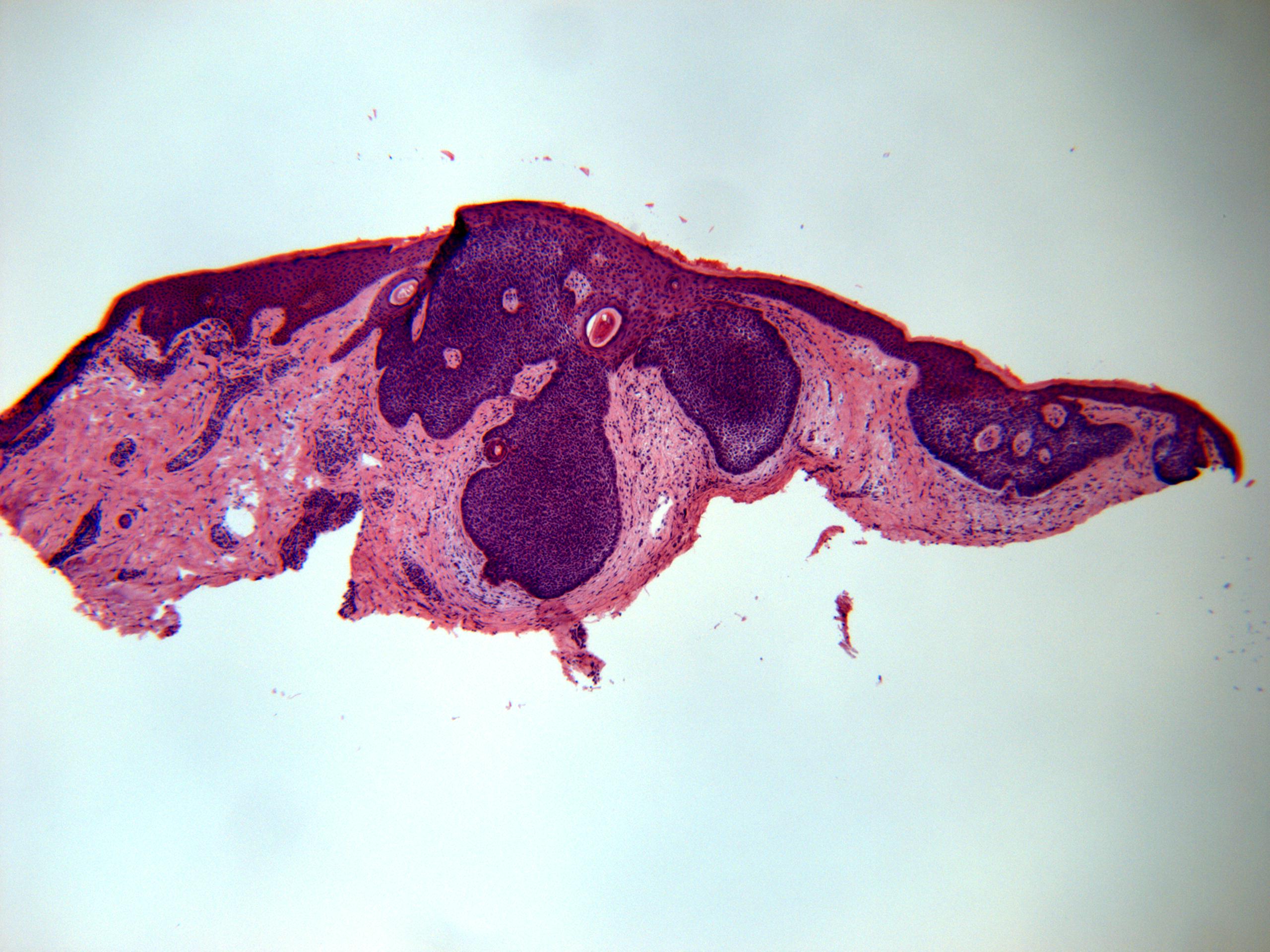 Basal Cell Carcinoma