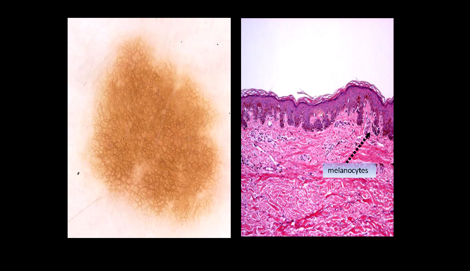 Fundamentals of Dermascopy: Terminology