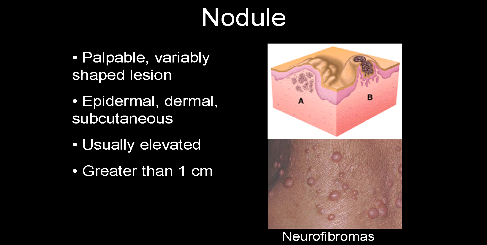 Benign neoplasms of the skin