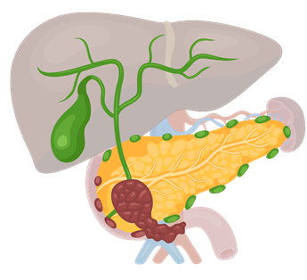 Graphic of Pancreatic Cancer