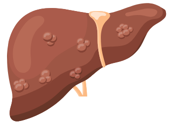 Graphic of Hepatocellular Carcinoma (Liver Cancer)