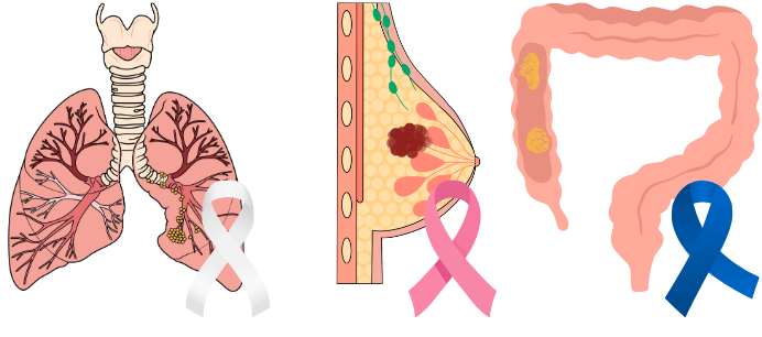Graphic showing examples of lung, breast and colon cancers next to their corresponding cancer ribbons