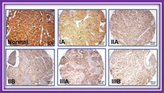 The Niacin/Butyrate Receptor GPR109A Suppresses Mammary Tumorigenesis By Inhibiting Cell Survival