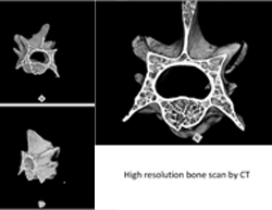 High resolution bone scan by CT