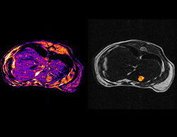 Liver Tumor Volumetric Segmentation