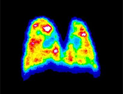 Lung Scan