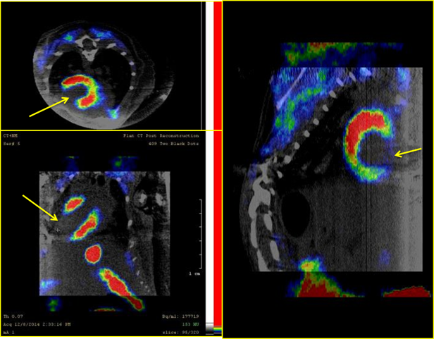 Myocardial Infarction