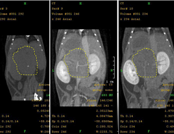 Neuroendocrine Tumor by CT Pre-Contrast, Arerial Phase, Venous Phase