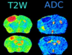 Restricted Diffusion in Acute Stroke