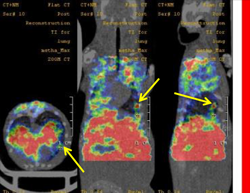 TI-201 Scan for Lung Meta