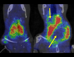 Thyroid Scan - normal and cancer