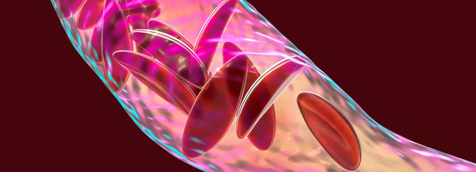 computer generated image of blood cells with sickle cell disease in veins