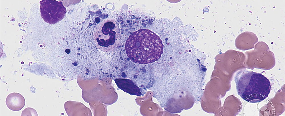 Phagocytic Macrophage