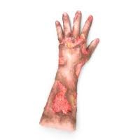 Integumentary by Wound Moulage