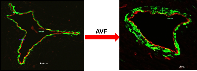 Regulation of arterial venous fistula (AVF) maturation