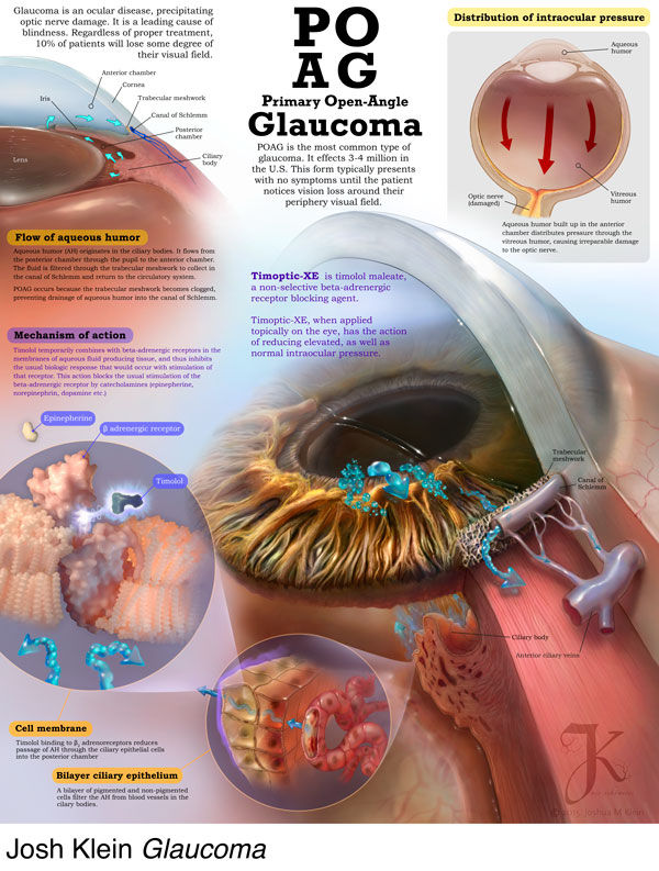 Glaucoma by Josh Klein