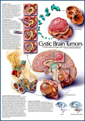 Swift brain tumors