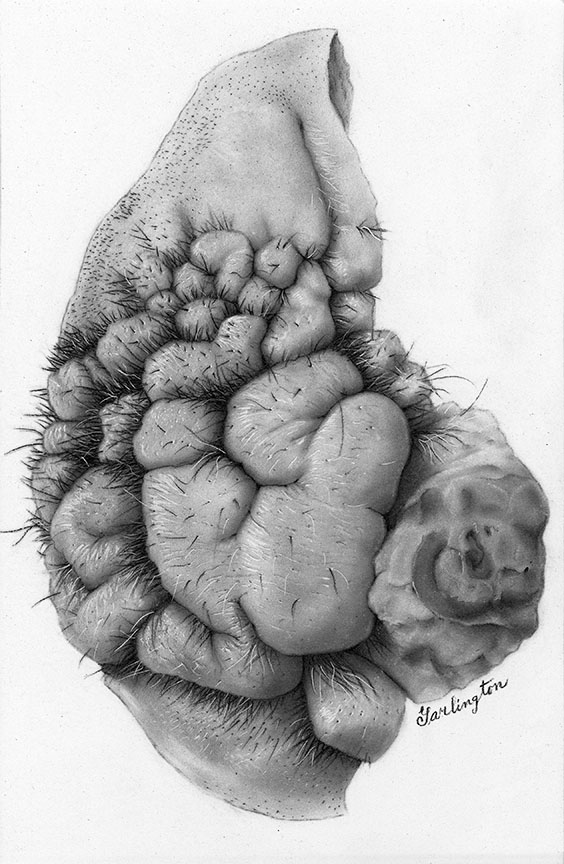 Drawing of a hairy nevus, by Octavia Garlington, 1961.