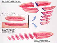Image showing the Mohs surgical process of removing the cancer in stages until no more of the tumor is present. This allows more healthy tissue to remain.