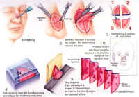 A schematic diagraming the stages of Mohs Micrographic Surgery showing the steps to remove the cancer.