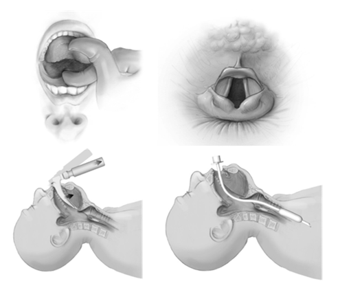Direct Laryngoscopy and Tracheal Intubation