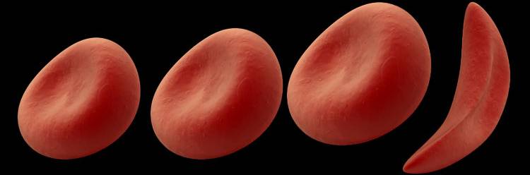 Sickle Cell image