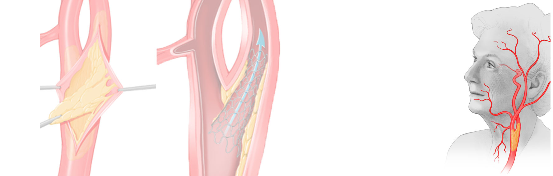 drawn example image of removing blockage from a woman's neck