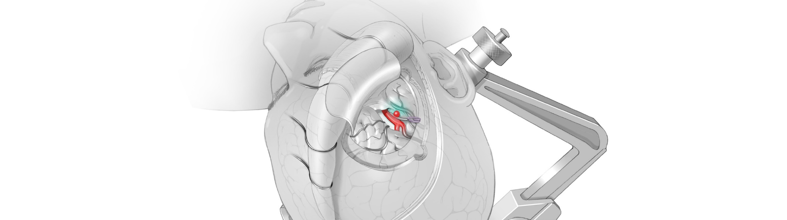 AU Stroke program image