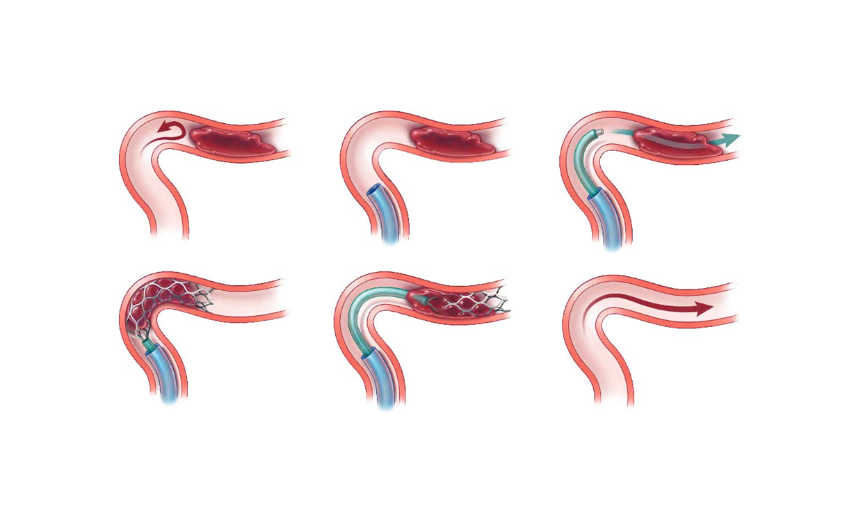 Mechanical Thrombechtomy steps