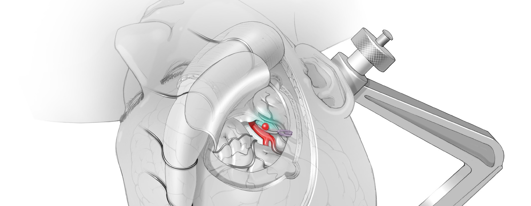 image of stroke