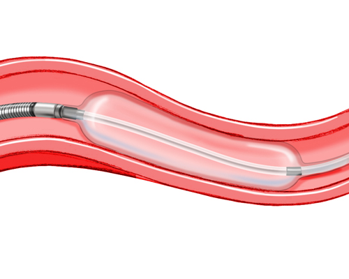 angioplasty