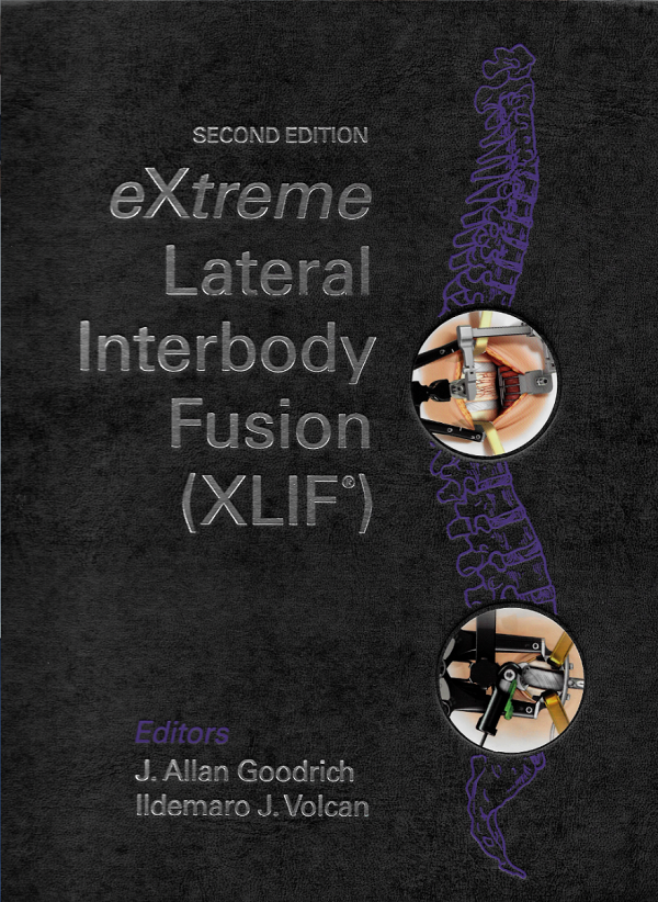 Dr. Volcan's Book cover: eXtreme Lateral Interbody Fusion (XLIF)