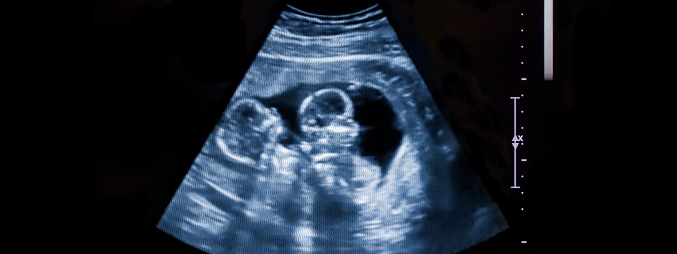 Ultrasound of a twin pregnancy