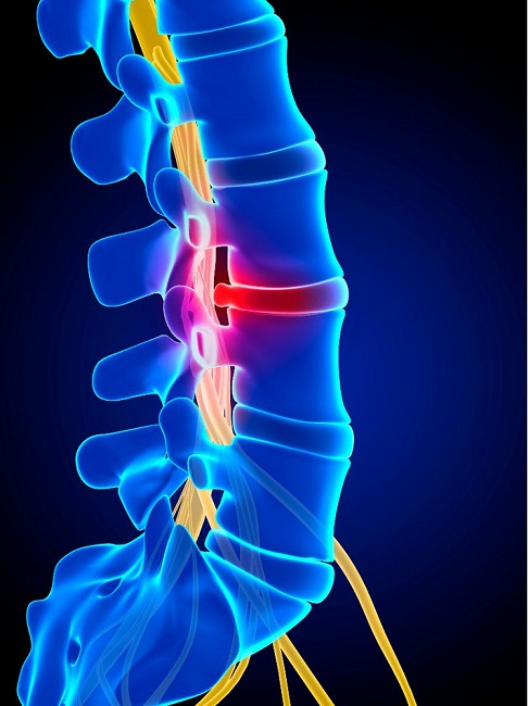 herniated disc x-ray