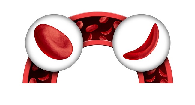 image of sickle cell and normal blood cells