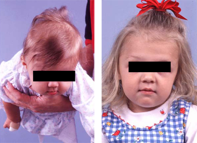 Plagiocephaly before and after