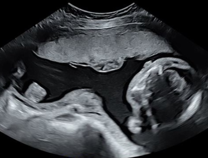 Anterior Placenta