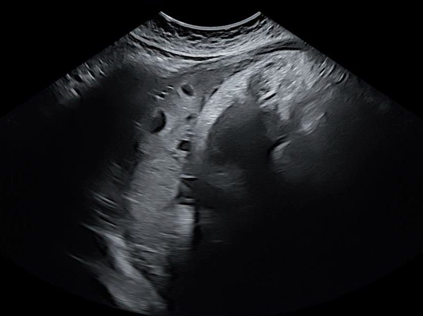 Fundal Placenta