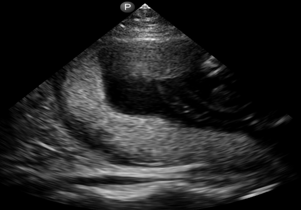 Posterior Placenta