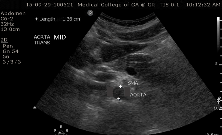 aorta transverse with sma