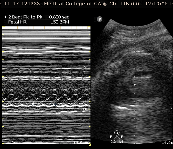 fetalheartrate