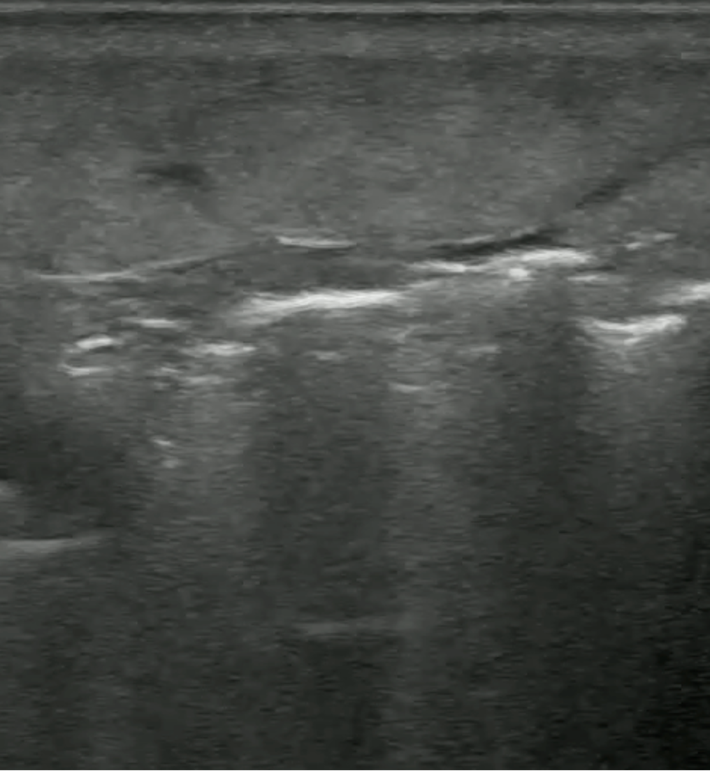 hyperechoiclines