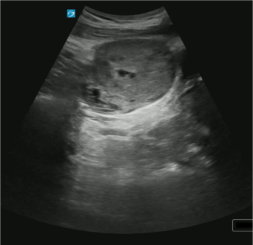 patultrasound1