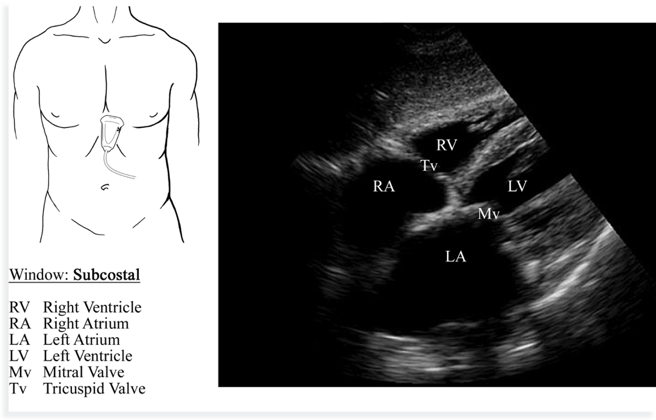 subcostal