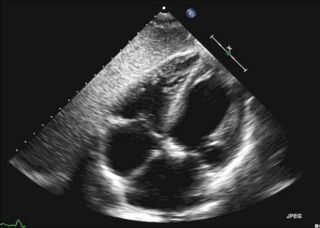 subcostal