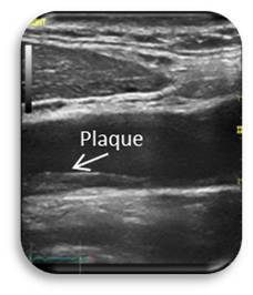 Diseased Carotid IMT